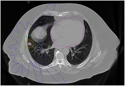 Stereotactic Body Radiotherapy (SBRT) for Oligometastatic Lung Nodules: A Single Institution Series